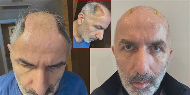 5 ay karnında taşıdığı kafatası kemikleri onu ikinci kez hayata bağladı