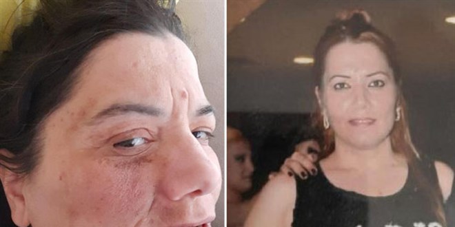 Damak tedavisinde yüz felci olan Yeliz, hayatını kaybetti