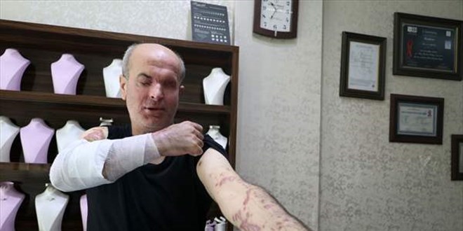 İş yerinin önünde kezzaplı saldırıya uğrayan kuyumcu sol gözünü kaybetti