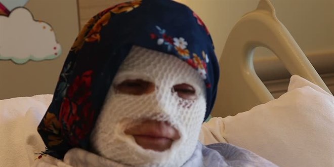Patlayan düdüklü tencere yüzünde ve vücudunda derin yanıklar oluşturdu